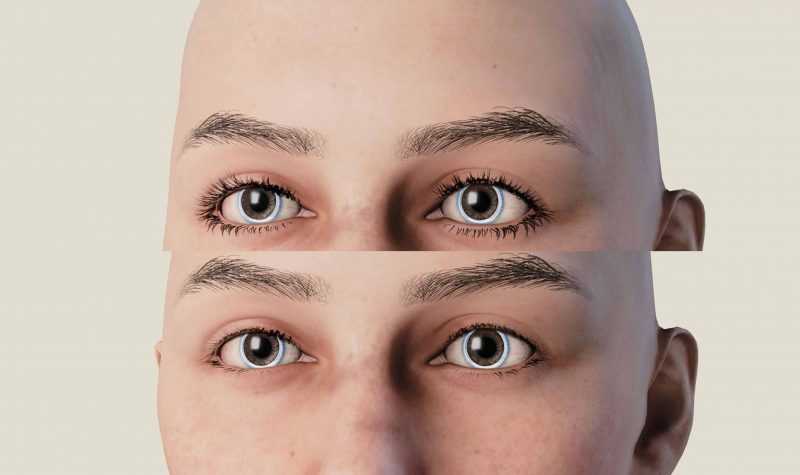 Less Severe Eyelashes